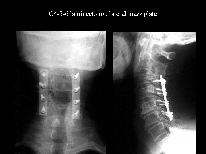 C 4 -5 -6 laminectomy, lateral mass plate 
