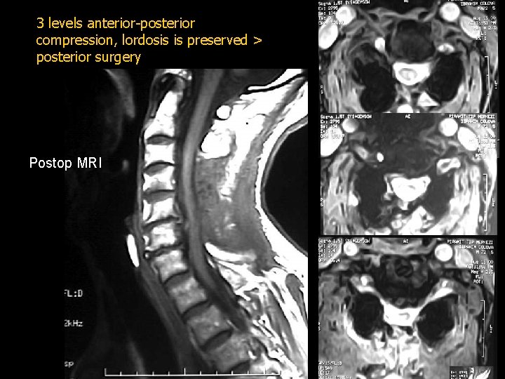 3 levels anterior-posterior compression, lordosis is preserved > posterior surgery Postop MRI 