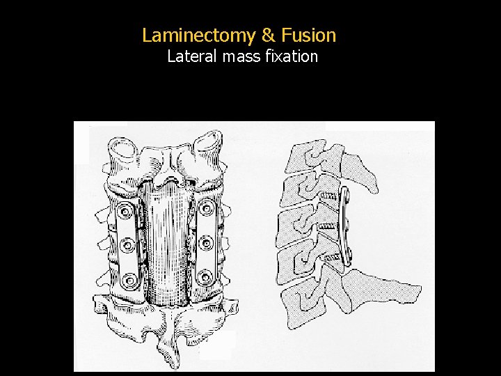 Laminectomy & Fusion Lateral mass fixation 