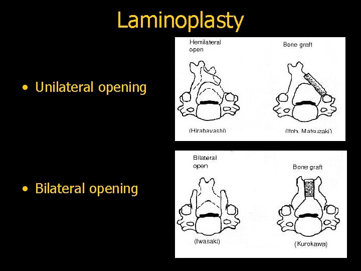Laminoplasty • Unilateral opening • Bilateral opening 