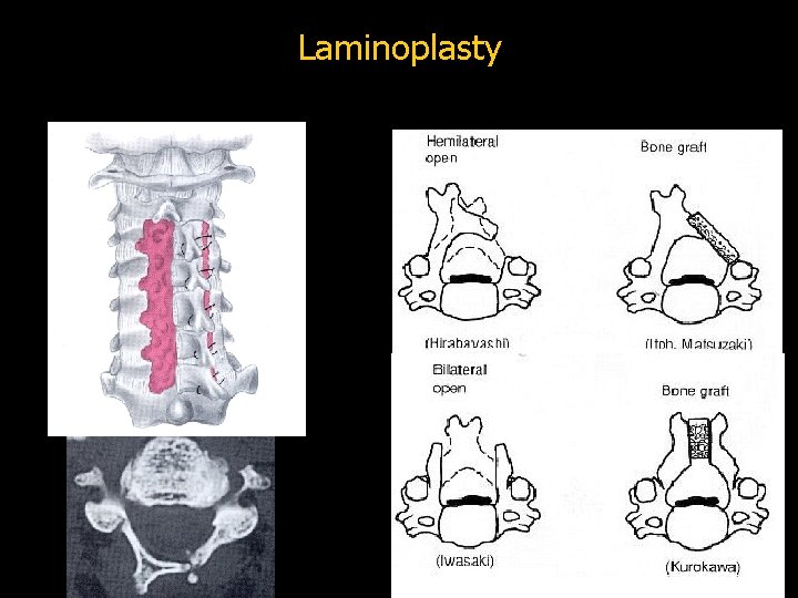 Laminoplasty 