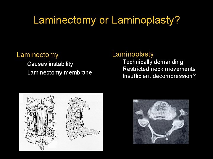 Laminectomy or Laminoplasty? Laminectomy Causes instability Laminectomy membrane Laminoplasty Technically demanding Restricted neck movements