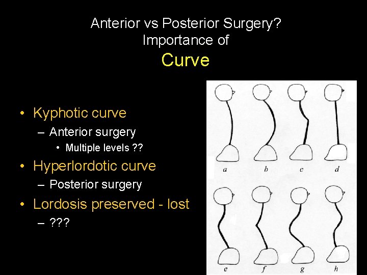 Anterior vs Posterior Surgery? Importance of Curve • Kyphotic curve – Anterior surgery •