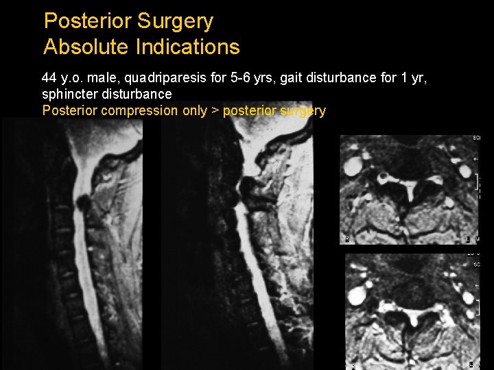 Posterior Surgery Absolute Indications 44 y. o. male, quadriparesis for 5 -6 yrs, gait