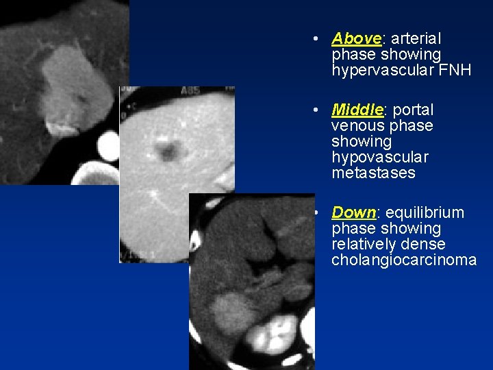 • Above: arterial phase showing hypervascular FNH • Middle: portal venous phase showing • Above: arterial phase showing hypervascular FNH • Middle: portal venous phase showing