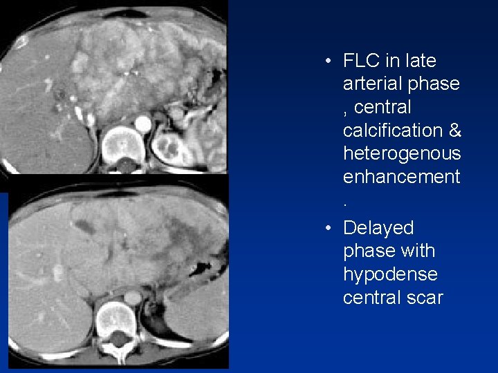 • FLC in late arterial phase , central calcification & heterogenous enhancement. • • FLC in late arterial phase , central calcification & heterogenous enhancement. •