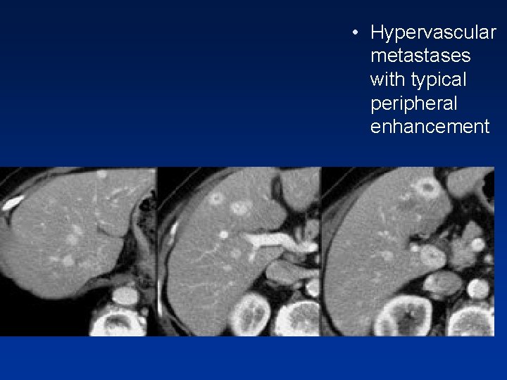 • Hypervascular metastases with typical peripheral enhancement • Hypervascular metastases with typical peripheral enhancement