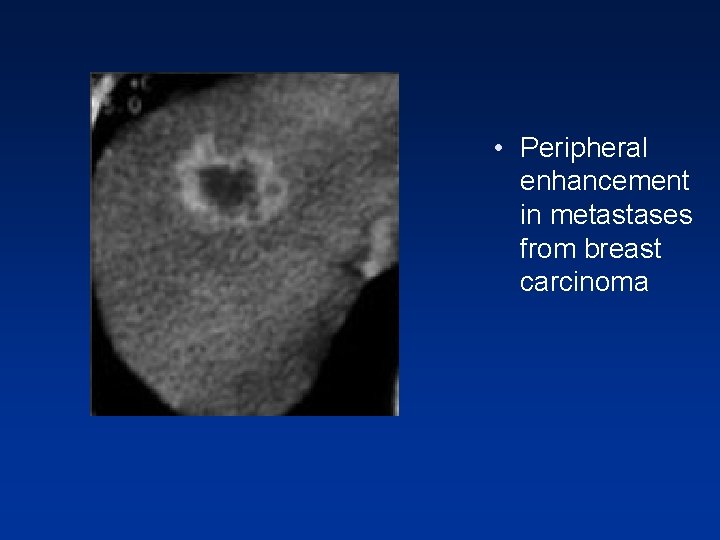 • Peripheral enhancement in metastases from breast carcinoma • Peripheral enhancement in metastases from breast carcinoma