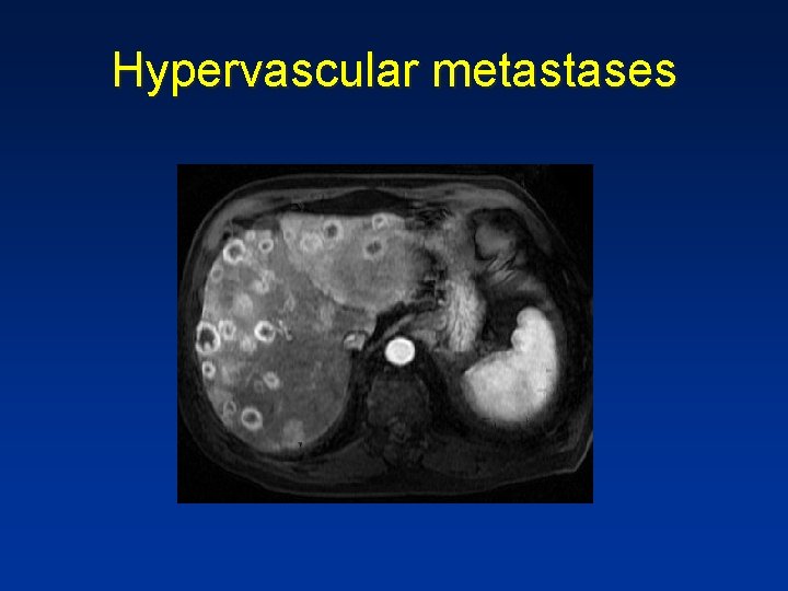 Hypervascular metastases Hypervascular metastases