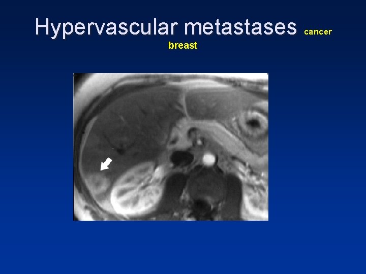 Hypervascular metastases breast cancer Hypervascular metastases breast cancer