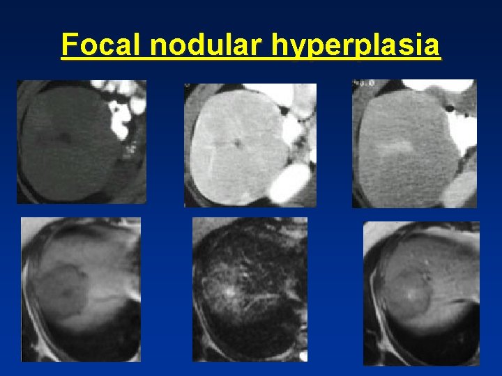 Focal nodular hyperplasia Focal nodular hyperplasia