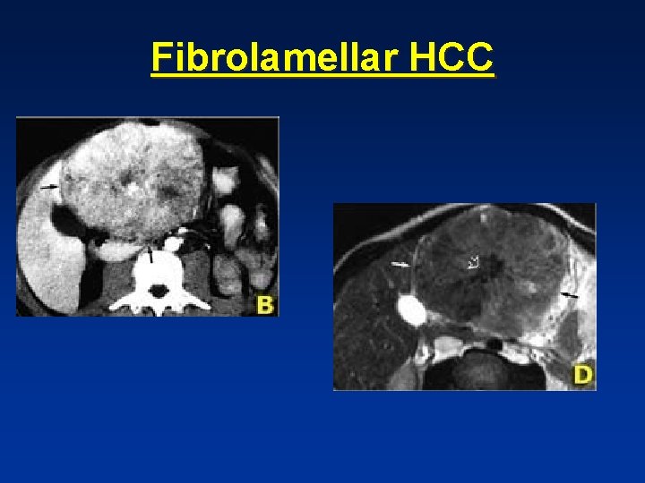 Fibrolamellar HCC Fibrolamellar HCC