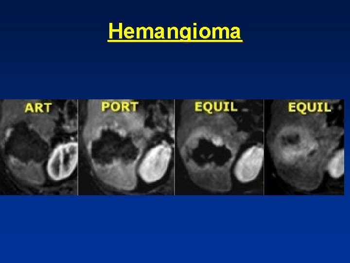 Hemangioma Hemangioma