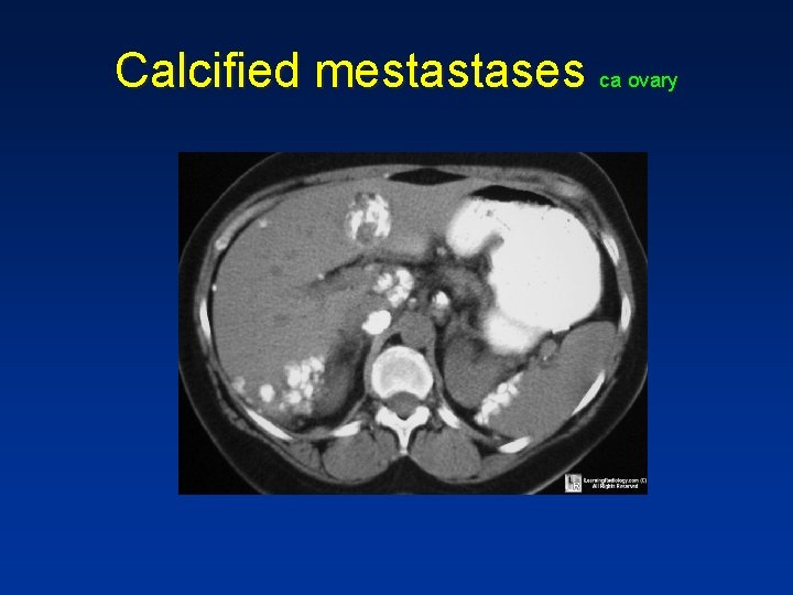 Calcified mestastases ca ovary Calcified mestastases ca ovary