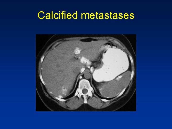 Calcified metastases Calcified metastases