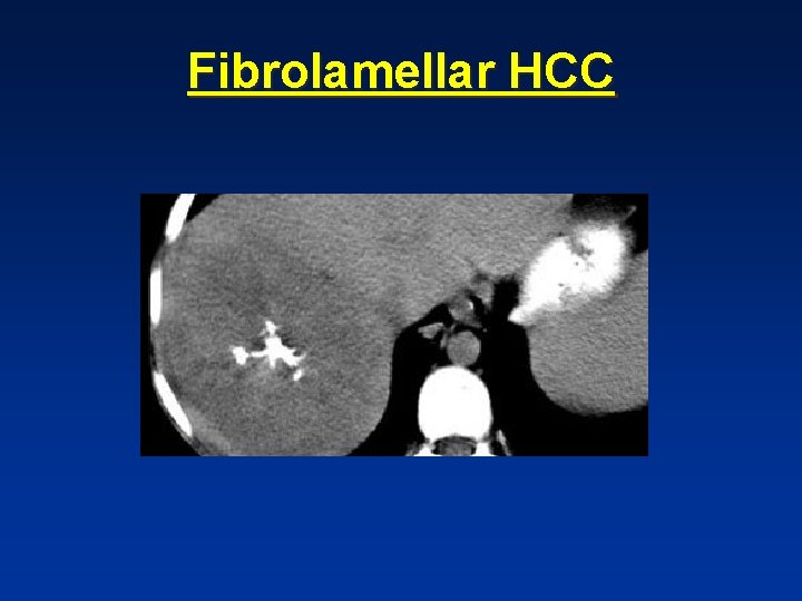 Fibrolamellar HCC Fibrolamellar HCC