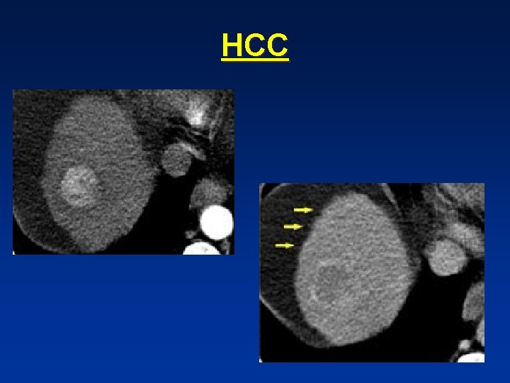 HCC HCC