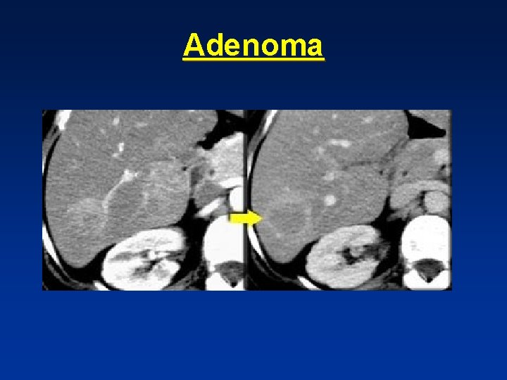 Adenoma Adenoma