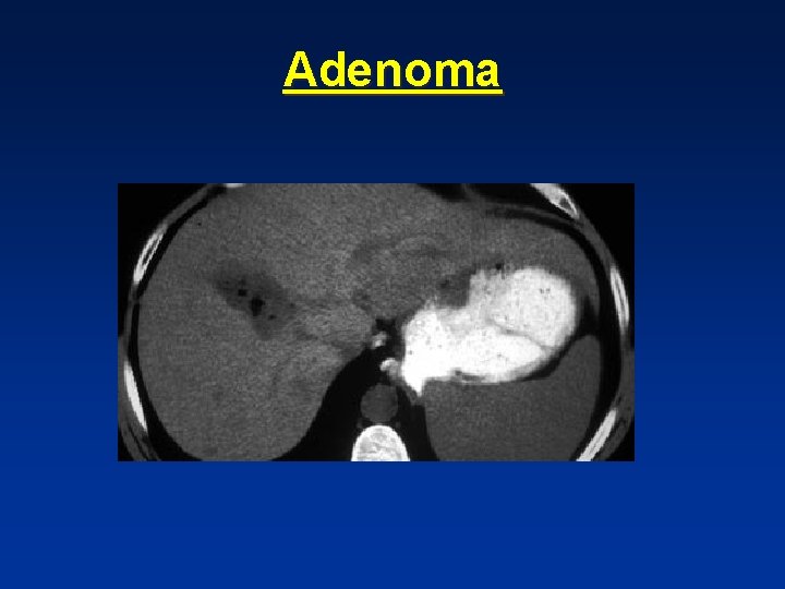 Adenoma Adenoma