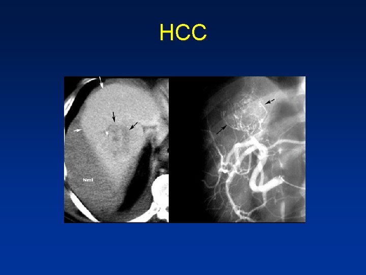 HCC HCC