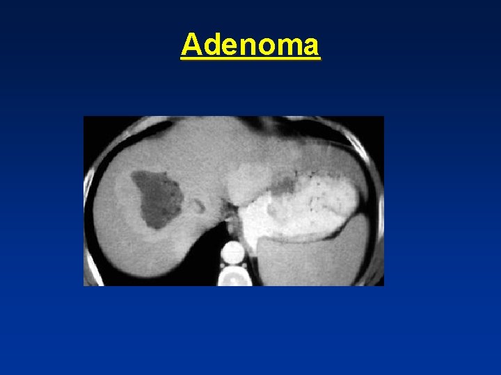 Adenoma Adenoma