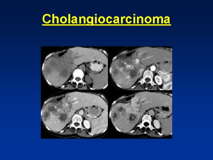 Cholangiocarcinoma Cholangiocarcinoma