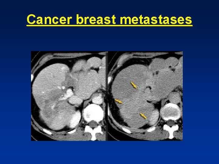 Cancer breast metastases Cancer breast metastases