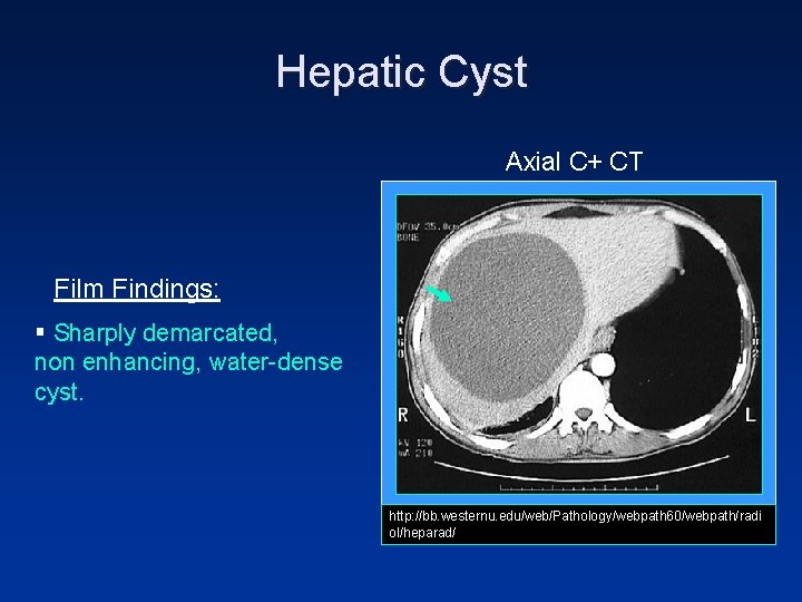 Hepatic Cyst Axial C+ CT Film Findings: § Sharply demarcated, non enhancing, water-dense cyst. Hepatic Cyst Axial C+ CT Film Findings: § Sharply demarcated, non enhancing, water-dense cyst.