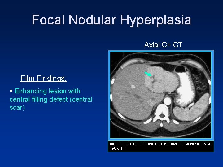 Focal Nodular Hyperplasia Axial C+ CT Film Findings: § Enhancing lesion with central filling Focal Nodular Hyperplasia Axial C+ CT Film Findings: § Enhancing lesion with central filling