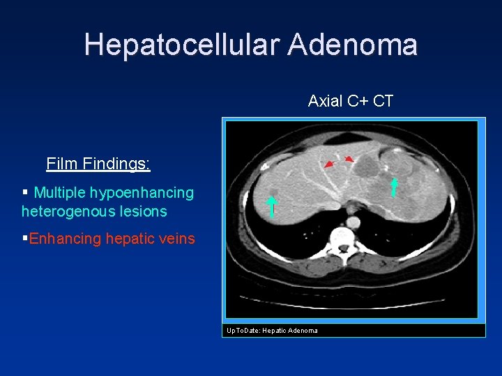 Hepatocellular Adenoma Axial C+ CT Film Findings: § Multiple hypoenhancing heterogenous lesions §Enhancing hepatic Hepatocellular Adenoma Axial C+ CT Film Findings: § Multiple hypoenhancing heterogenous lesions §Enhancing hepatic