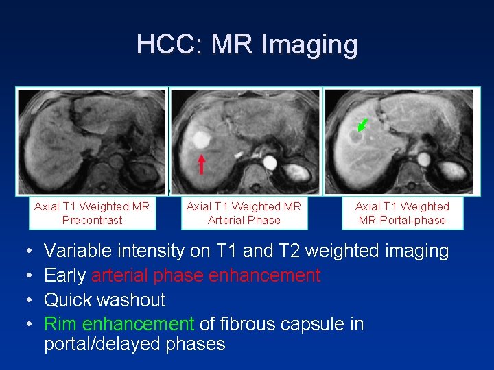 HCC: MR Imaging Axial T 1 Weighted MR Precontrast • • Axial T 1 HCC: MR Imaging Axial T 1 Weighted MR Precontrast • • Axial T 1