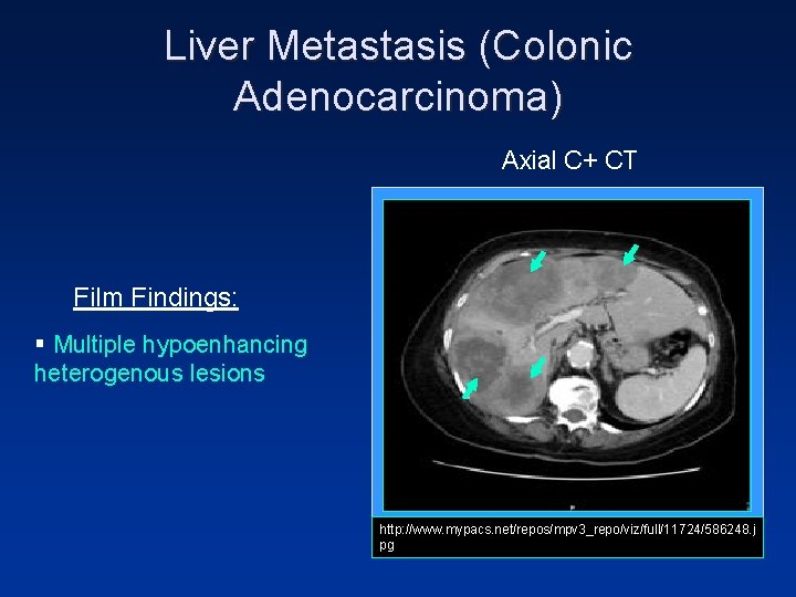 Liver Metastasis (Colonic Adenocarcinoma) Axial C+ CT Film Findings: § Multiple hypoenhancing heterogenous lesions Liver Metastasis (Colonic Adenocarcinoma) Axial C+ CT Film Findings: § Multiple hypoenhancing heterogenous lesions