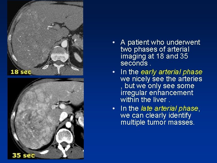 • A patient who underwent two phases of arterial imaging at 18 and • A patient who underwent two phases of arterial imaging at 18 and