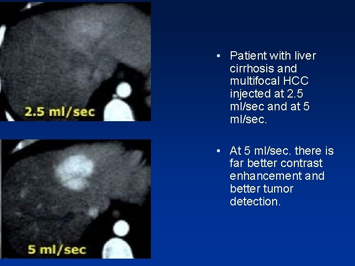 • Patient with liver cirrhosis and multifocal HCC injected at 2. 5 ml/sec • Patient with liver cirrhosis and multifocal HCC injected at 2. 5 ml/sec