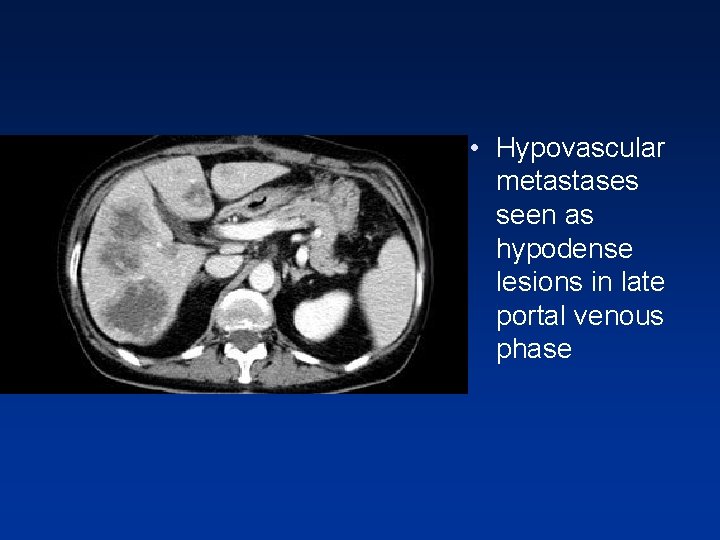 • Hypovascular metastases seen as hypodense lesions in late portal venous phase • Hypovascular metastases seen as hypodense lesions in late portal venous phase