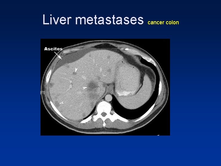 Liver metastases cancer colon Liver metastases cancer colon