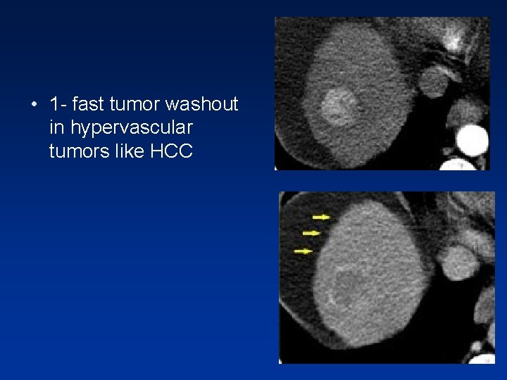 • 1 - fast tumor washout in hypervascular tumors like HCC • 1 - fast tumor washout in hypervascular tumors like HCC