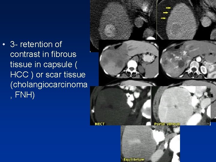 • 3 - retention of contrast in fibrous tissue in capsule ( HCC • 3 - retention of contrast in fibrous tissue in capsule ( HCC