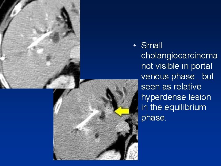 • Small cholangiocarcinoma not visible in portal venous phase , but seen as • Small cholangiocarcinoma not visible in portal venous phase , but seen as