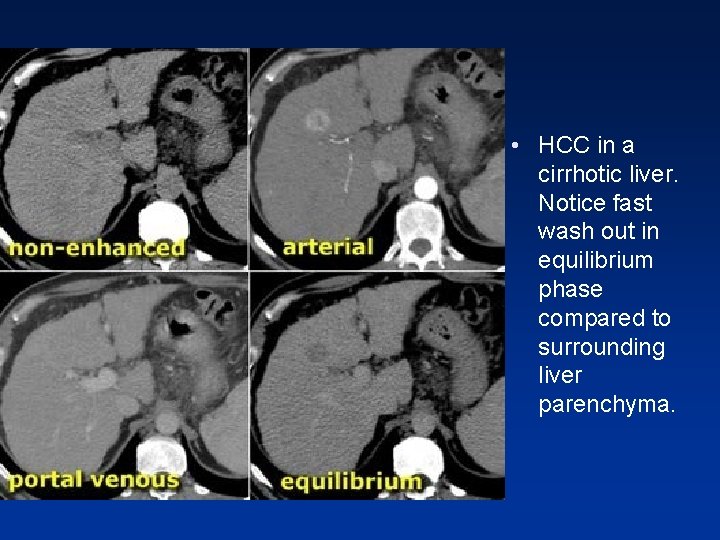 • HCC in a cirrhotic liver. Notice fast wash out in equilibrium phase • HCC in a cirrhotic liver. Notice fast wash out in equilibrium phase
