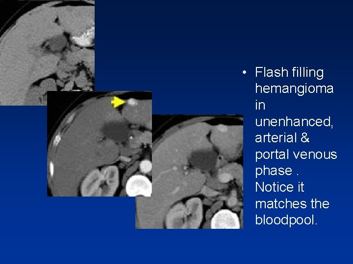• Flash filling hemangioma in unenhanced, arterial & portal venous phase. Notice it • Flash filling hemangioma in unenhanced, arterial & portal venous phase. Notice it
