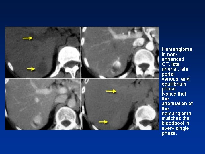 • Hemangioma in nonenhanced CT, late arterial, late portal venous, and equilibrium phase. • Hemangioma in nonenhanced CT, late arterial, late portal venous, and equilibrium phase.