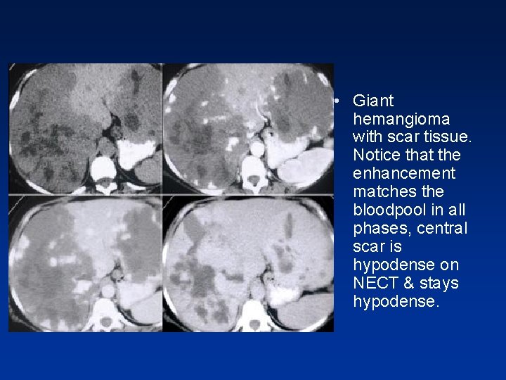 • Giant hemangioma with scar tissue. Notice that the enhancement matches the bloodpool • Giant hemangioma with scar tissue. Notice that the enhancement matches the bloodpool