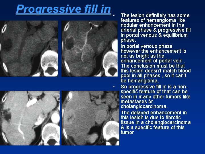 Progressive fill in • • The lesion definitely has some features of hemangioma like Progressive fill in • • The lesion definitely has some features of hemangioma like