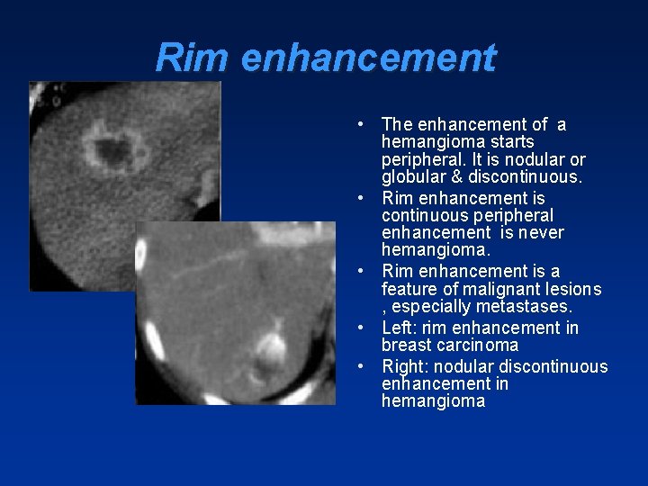 Rim enhancement • The enhancement of a hemangioma starts peripheral. It is nodular or Rim enhancement • The enhancement of a hemangioma starts peripheral. It is nodular or