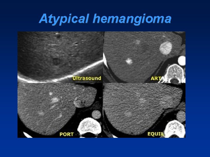 Atypical hemangioma Atypical hemangioma