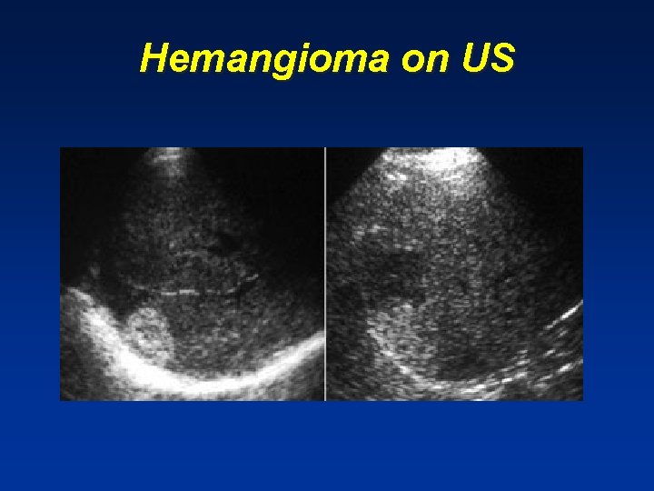 Hemangioma on US Hemangioma on US