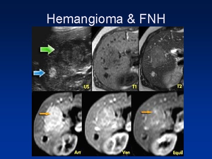 Hemangioma & FNH Hemangioma & FNH