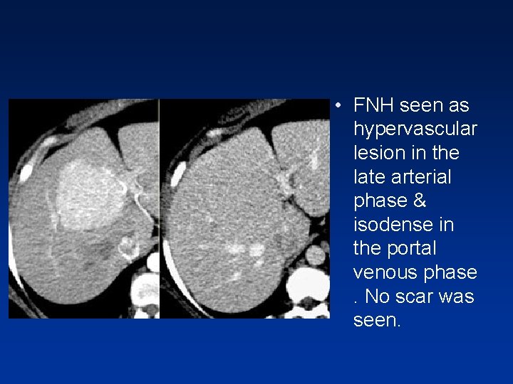 • FNH seen as hypervascular lesion in the late arterial phase & isodense • FNH seen as hypervascular lesion in the late arterial phase & isodense
