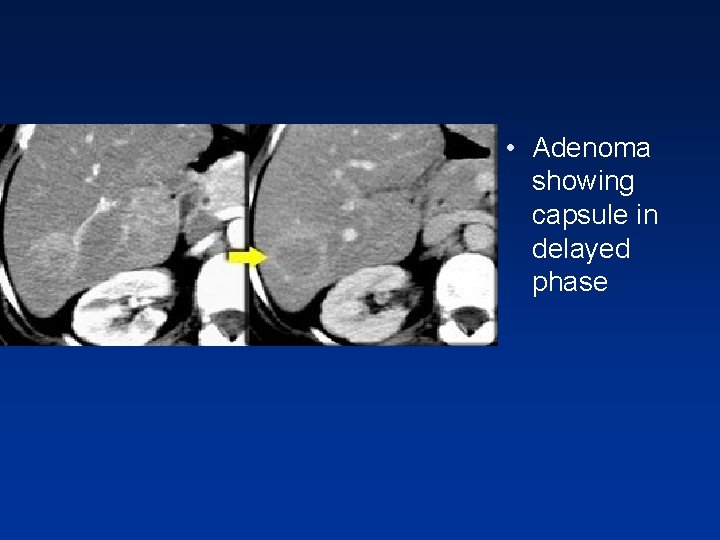 • Adenoma showing capsule in delayed phase • Adenoma showing capsule in delayed phase